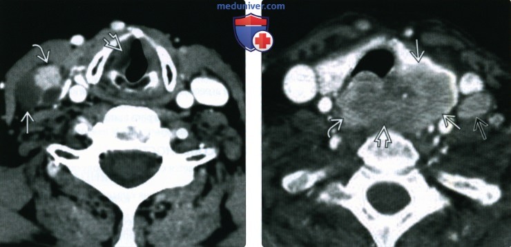 КТ, МРТ, УЗИ при дифференцированном раке щитовидной железы