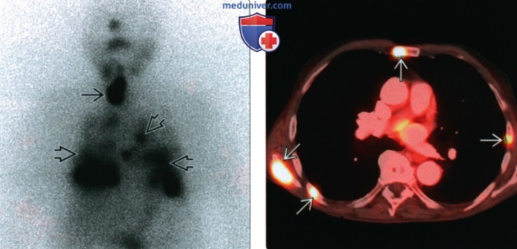 КТ, МРТ, УЗИ при дифференцированном раке щитовидной железы