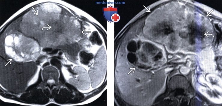КТ, МРТ, УЗИ признаки фиброламеллярного рака печени