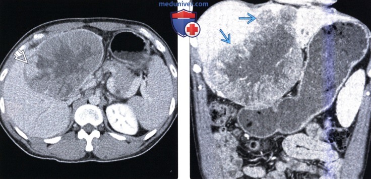 КТ, МРТ, УЗИ признаки фиброламеллярного рака печени