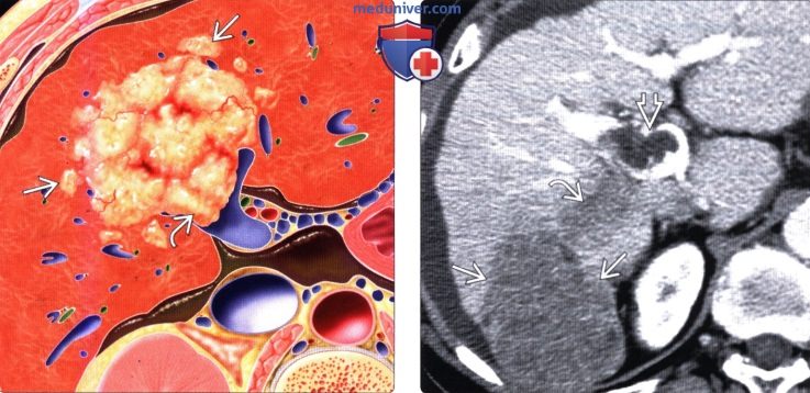 КТ, МРТ, УЗИ признаки гепатоцеллюлярного рака печени