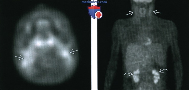 КТ, МРТ, УЗИ при гигантской гиперплазии лимфатических узлов шеи (болезни Кастлемана)
