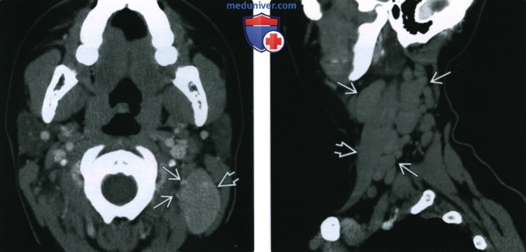 КТ, МРТ, УЗИ при гигантской гиперплазии лимфатических узлов шеи (болезни Кастлемана)