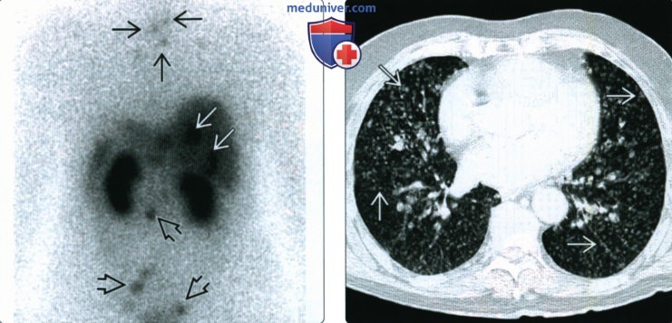 КТ, МРТ, УЗИ при медуллярном раке щитовидной железы