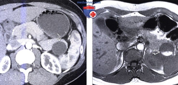 КТ, МРТ, УЗИ признаки муцинозной кистозной опухоли поджелудочной железы
