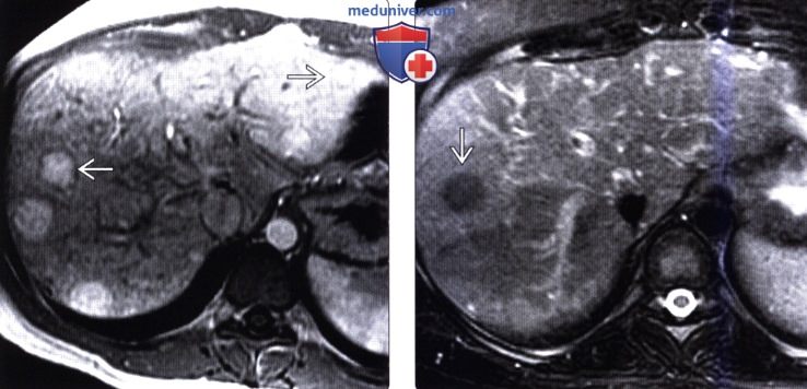КТ, МРТ, УЗИ признаки нодулярной регенераторной гиперплазии печени