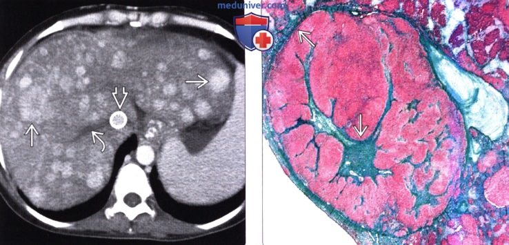 КТ, МРТ, УЗИ признаки нодулярной регенераторной гиперплазии печени