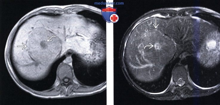 КТ, МРТ, УЗИ признаки очаговой узелковой гиперплазии печени