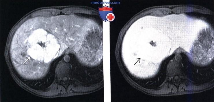 КТ, МРТ, УЗИ признаки очаговой узелковой гиперплазии печени