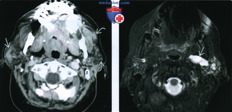 КТ, МРТ, УЗИ околоушной железы при синдроме Шегрена