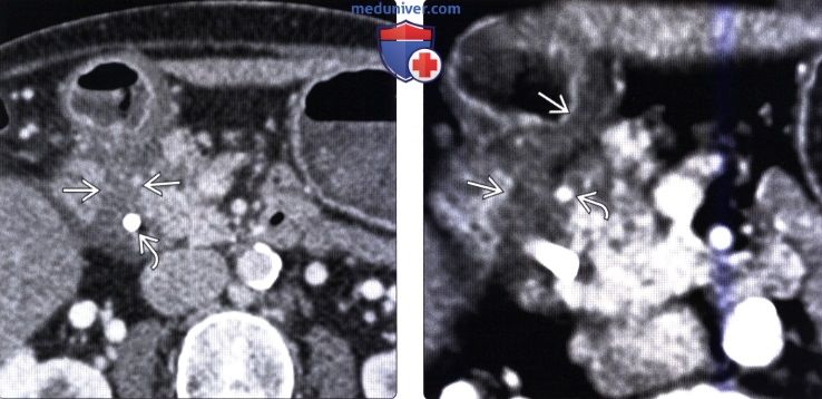 КТ, МРТ, УЗИ признаки парадуоденального (бороздчатого) панкреатита