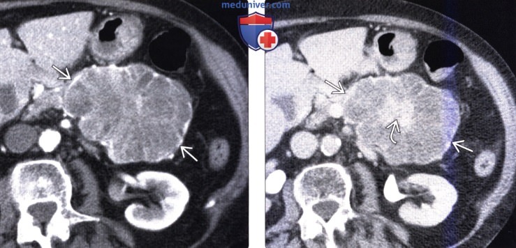 КТ, МРТ, УЗИ признаки серозной цистаденомы поджелудочной железы