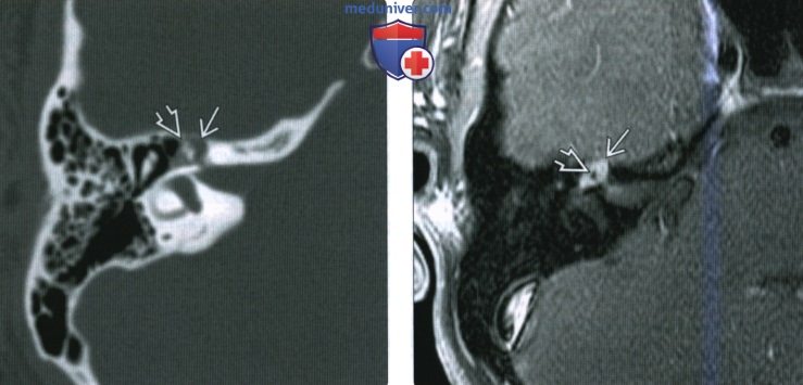 КТ, МРТ при венозной мальформации лицевого нерва (ВМЛН) в височной кости