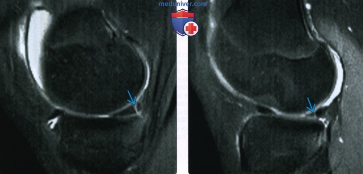 КТ, МРТ при вертикальном продольном разрыве мениска коленного сустава