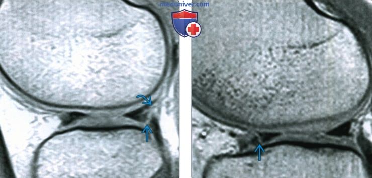 КТ, МРТ при вертикальном продольном разрыве мениска коленного сустава