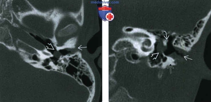 КТ, МРТ при врожденной мальформации наружного и среднего уха