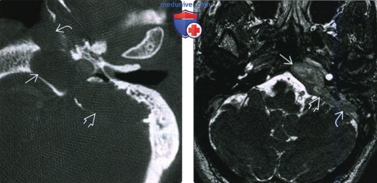 КТ, МРТ при врожденной холестеатоме вершины пирамиды височной кости