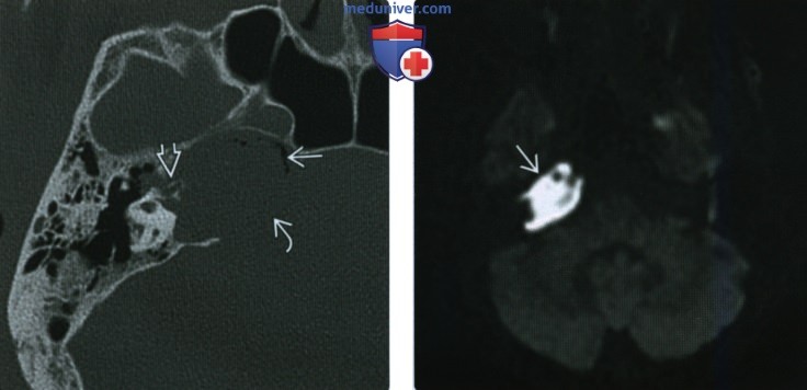 КТ, МРТ при врожденной холестеатоме вершины пирамиды височной кости