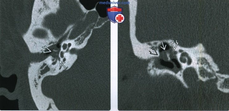 КТ, МРТ при холестеатоме ненатянутой части барабанной перепонки