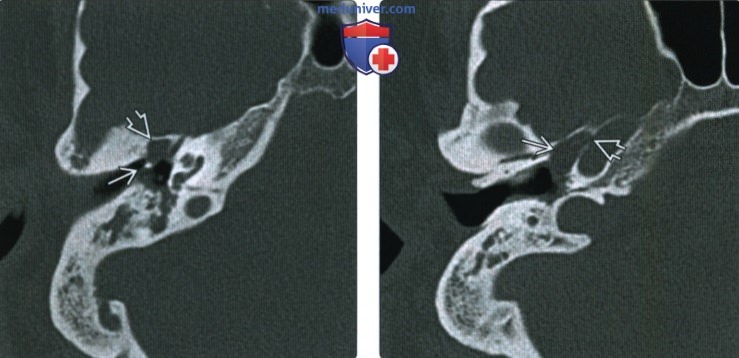 КТ, МРТ при холестеатоме натянутой части барабанной перегородки