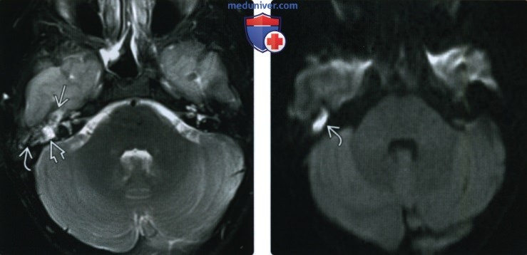 КТ, МРТ при холестеатоме натянутой части барабанной перегородки