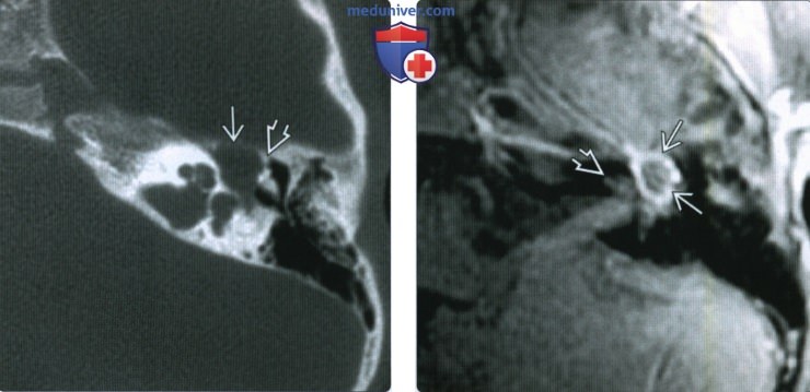 КТ, МРТ при врожденной холестеатоме среднего уха