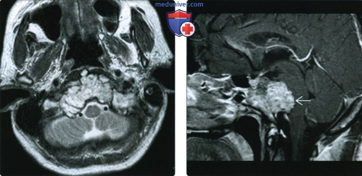 КТ, МРТ при хордоме затылочной кости (основания черепа)