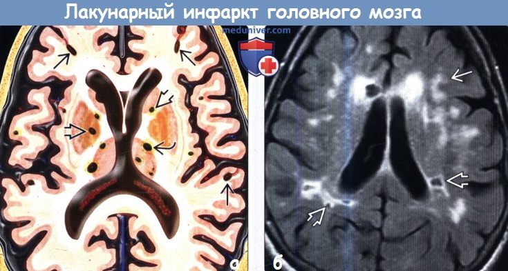 Лакунарный инфаркт головного мозга на МРТ