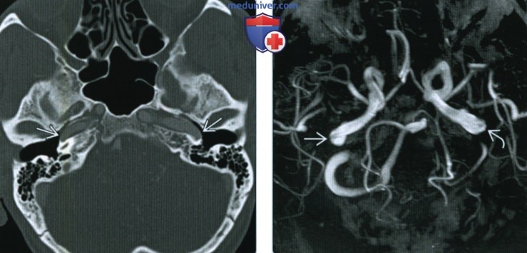 Латерализация внутренней сонной артерии (лат-ВСА) - лучевая диагностика