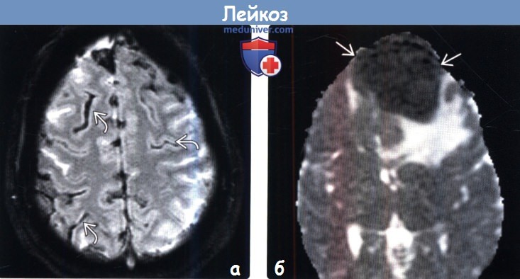 Лейкоз головного мозга на КТ, МРТ