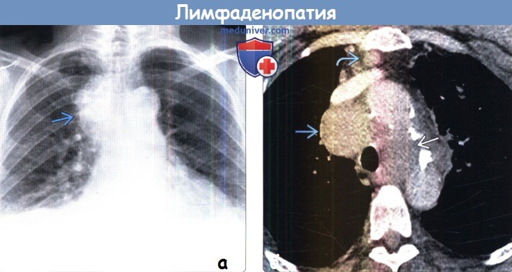 Лимфаденопатия средостения на рентгенограмме и КТ