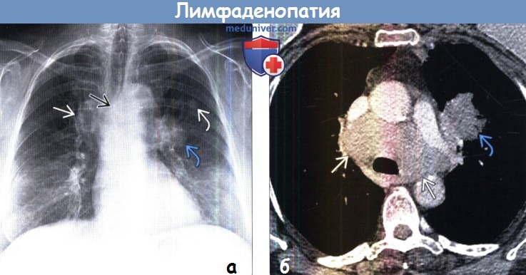 Лимфаденопатия средостения на рентгенограмме и КТ