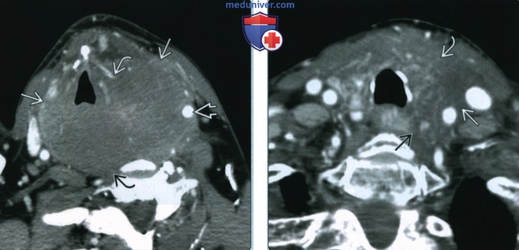 Неходжкинская лимфома щитовидной железы - лучевая диагностика