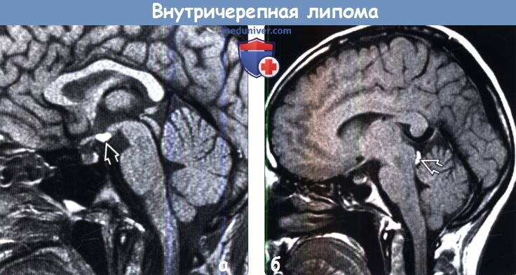 Липома головного мозга на МРТ