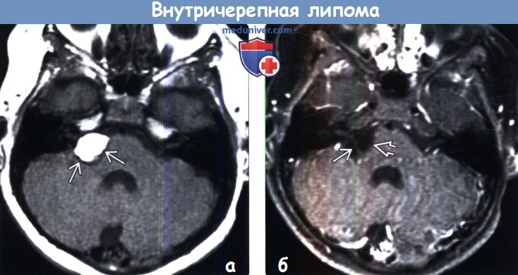 Липома головного мозга на МРТ