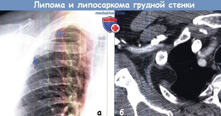 Липома и липосаркома грудной стенки на рентгенограмме, КТ