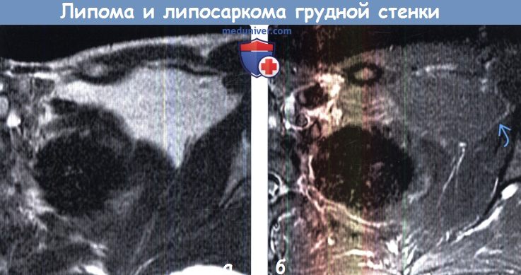 Липома и липосаркома грудной стенки на МРТ