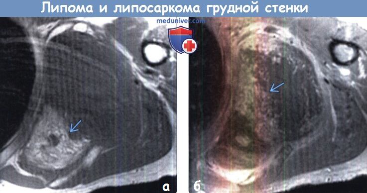 Липома и липосаркома грудной стенки на МРТ