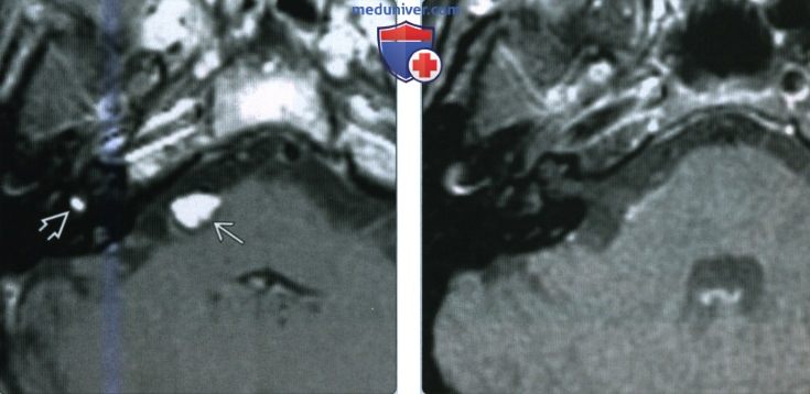 Липома мостомозжечкового угла (ММУ) и внутреннего слухового канала (ВСК) - лучевая диагностика