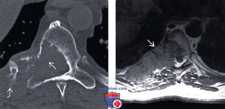 Рентгенограмма, КТ, МРТ литических костных метастазов позвоночника