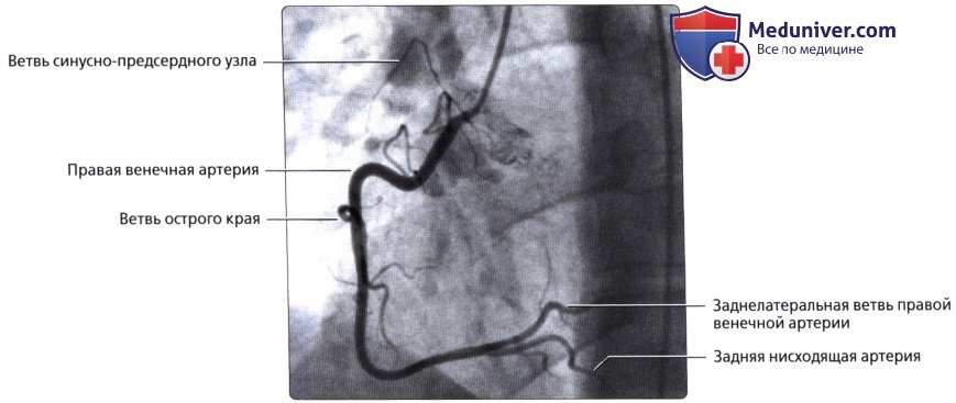 Лучевая анатомия коронарных артерий и вен сердца
