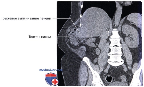 Лучевая анатомия (КТ, МРТ анатомия) брюшной стенки