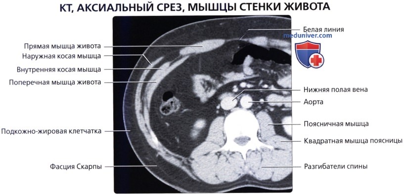 Лучевая анатомия (КТ, МРТ анатомия) брюшной стенки