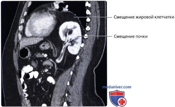 Лучевая анатомия (КТ, МРТ анатомия) диафрагмы