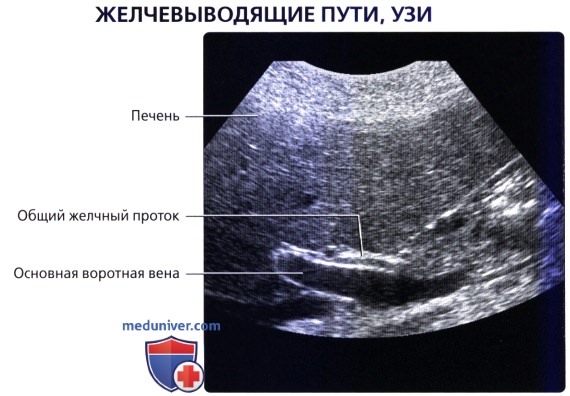 Лучевая анатомия (КТ, МРТ анатомия) желчевыводящей системы