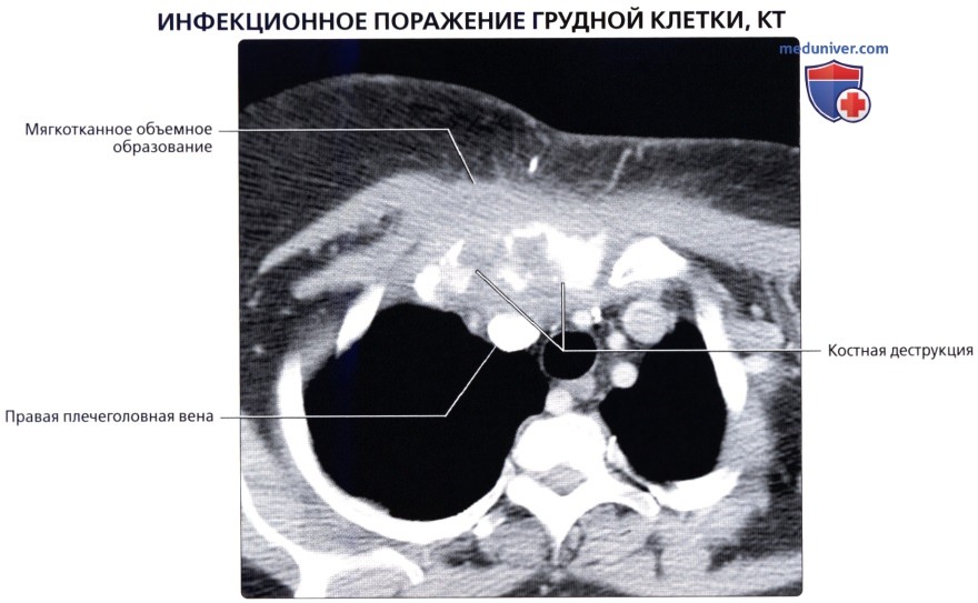 Лучевая анатомия (КТ, МРТ анатомия) грудной стенки