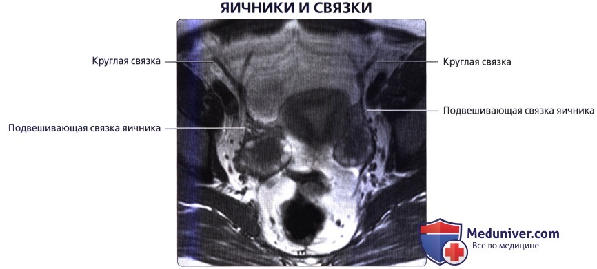 Лучевая анатомия (КТ, МРТ анатомия) яичника