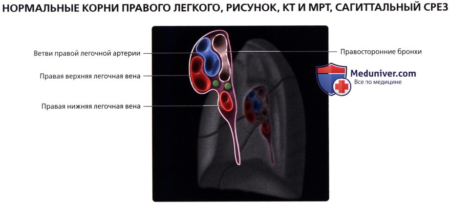Лучевая анатомия (рентген, КТ анатомия) корней легких