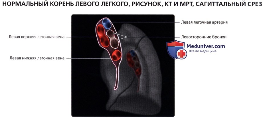 Лучевая анатомия (рентген, КТ анатомия) корней легких