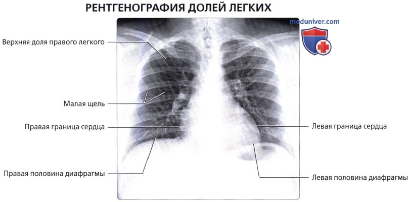 Лучевая анатомия (рентген, КТ анатомия) легких